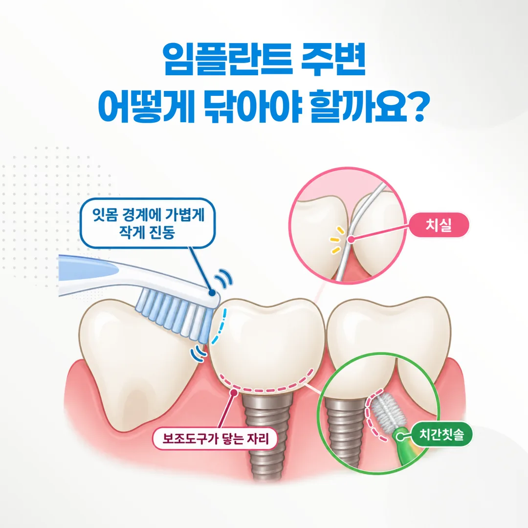임플란트 주변을 닦을 때 칫솔 각도와 보조 도구가 맡는 자리를 보여주는 그림