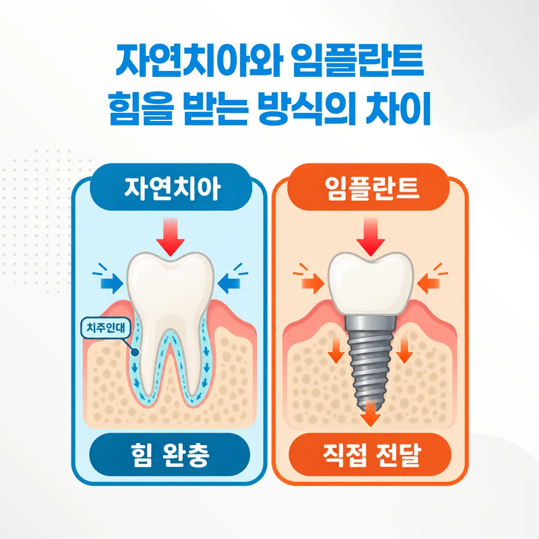치주인대가 있는 자연치아와 없는 임플란트의 힘 전달 비교 개념도