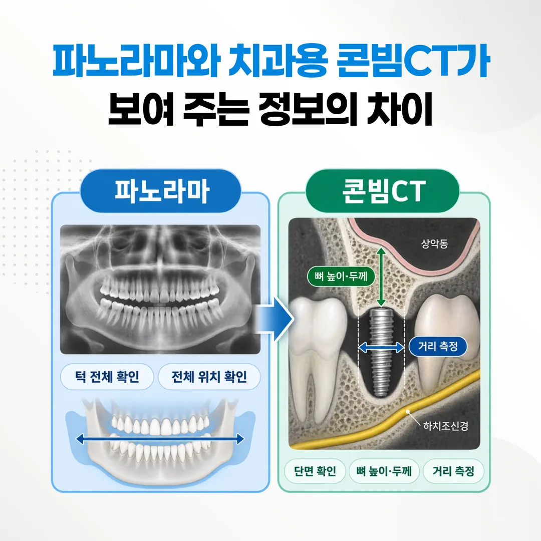파노라마와 치과용 콘빔CT가 보여 주는 정보의 차이를 정리한 개념도