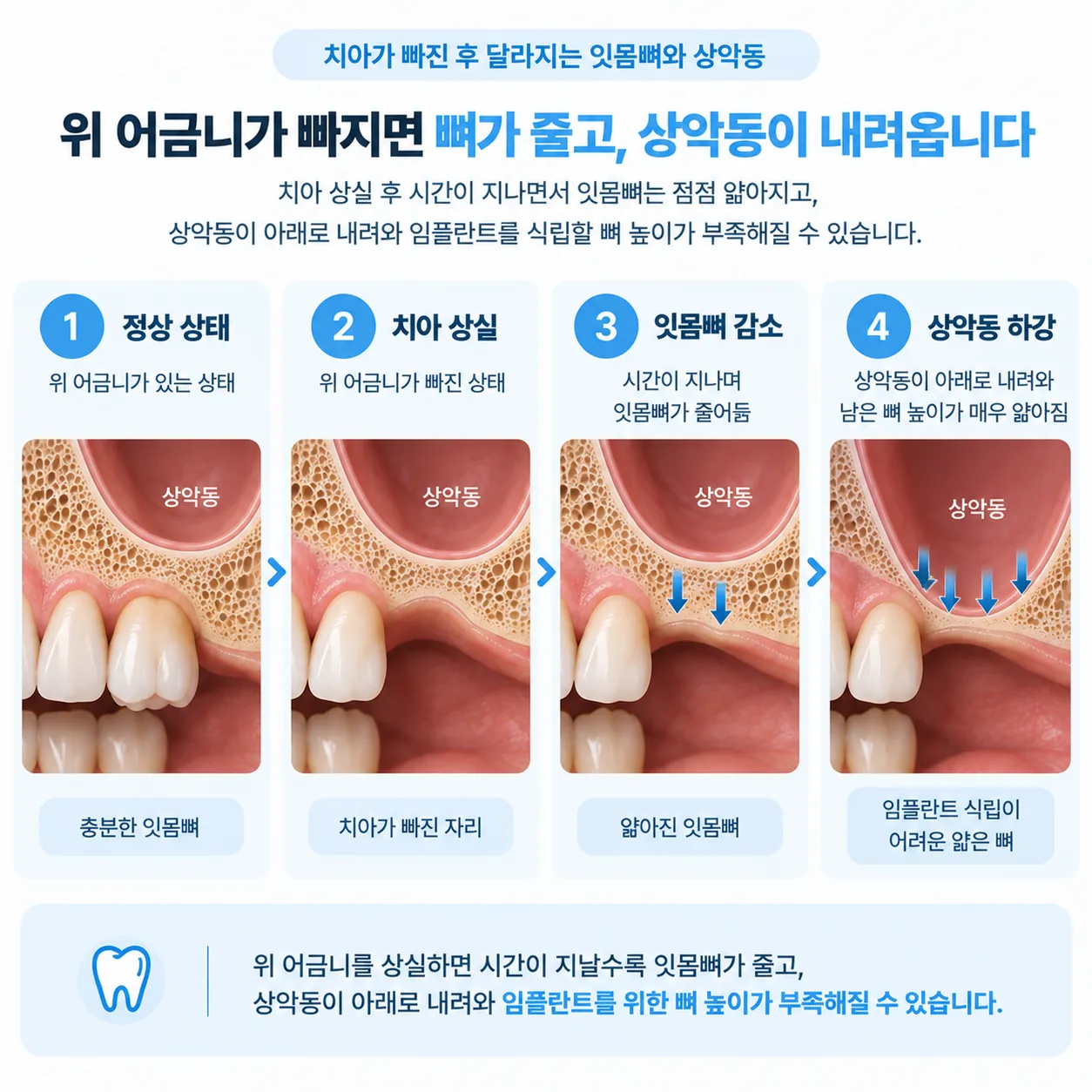 위 어금니 상실 후 상악동 함기화로 잔존 골 높이가 줄어드는 과정을 보여주는 도해