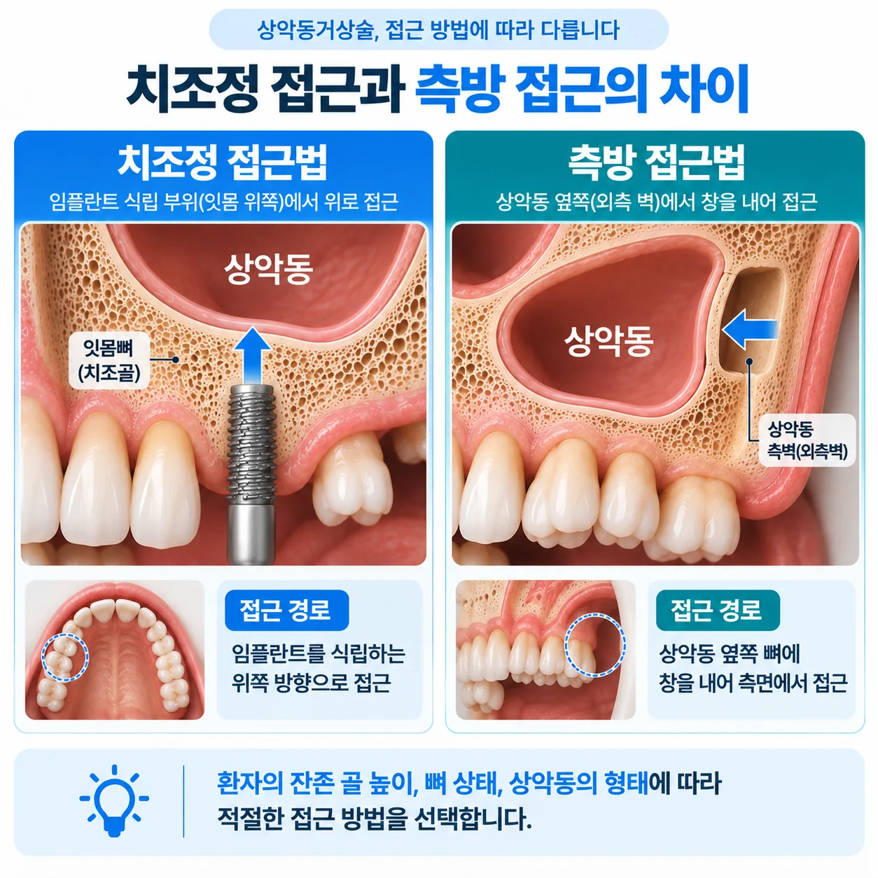 상악동거상술 치조정 접근법과 측방 접근법의 진입 경로를 비교한 단면 도해