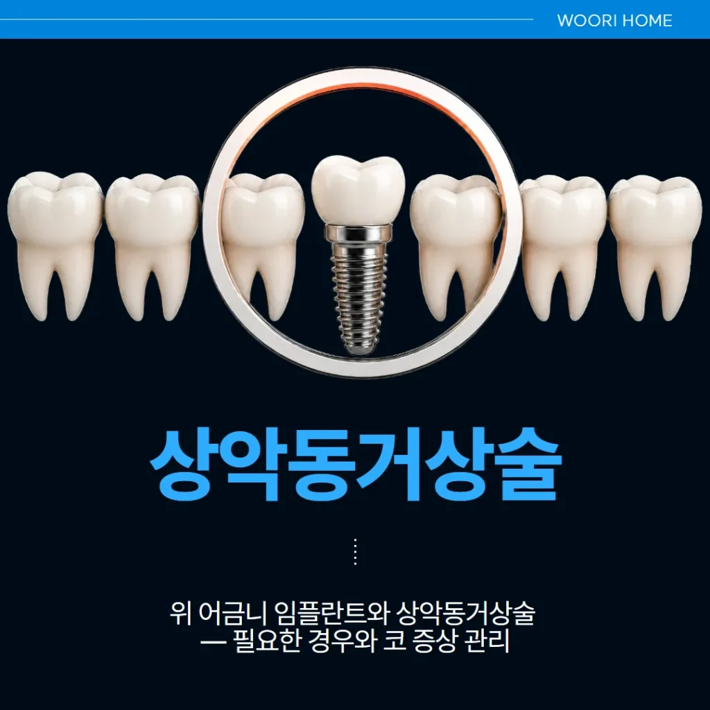 위 어금니 임플란트와 상악동거상술 — 필요한 경우와 코 증상 관리