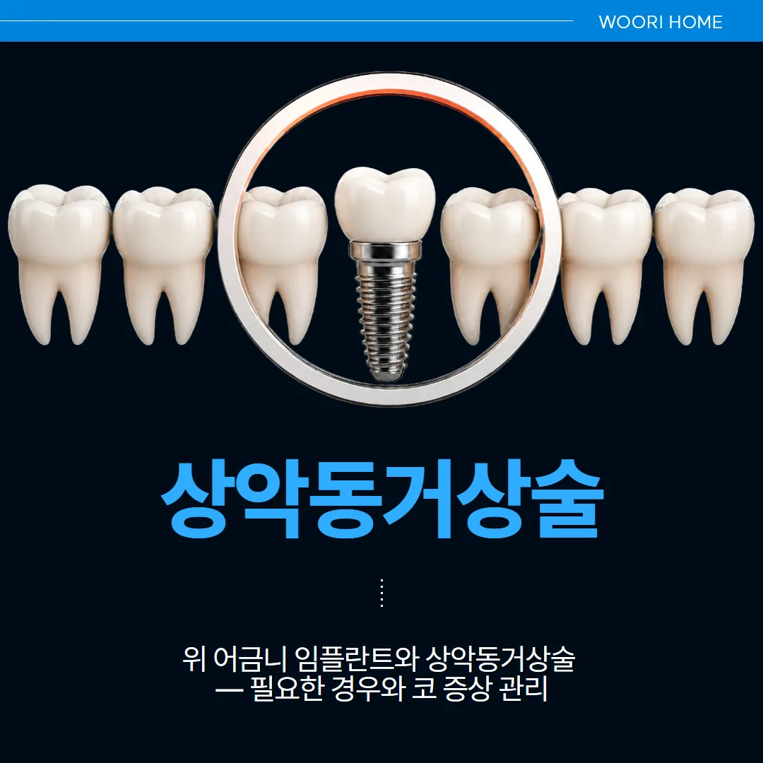 위 어금니 임플란트와 상악동거상술 — 필요한 경우와 코 증상 관리