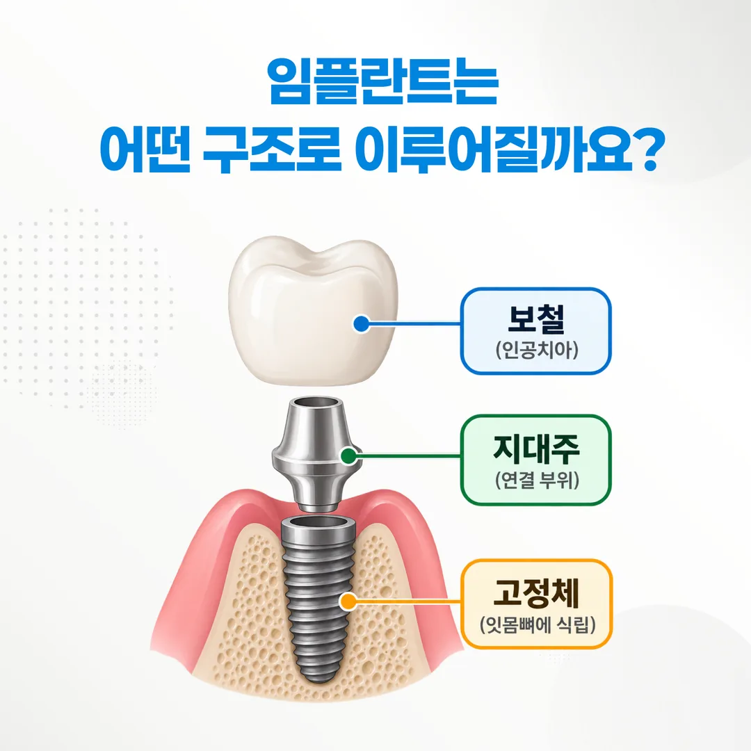 임플란트 고정체와 지대주, 보철 세 부분을 나눈 구조 개념도