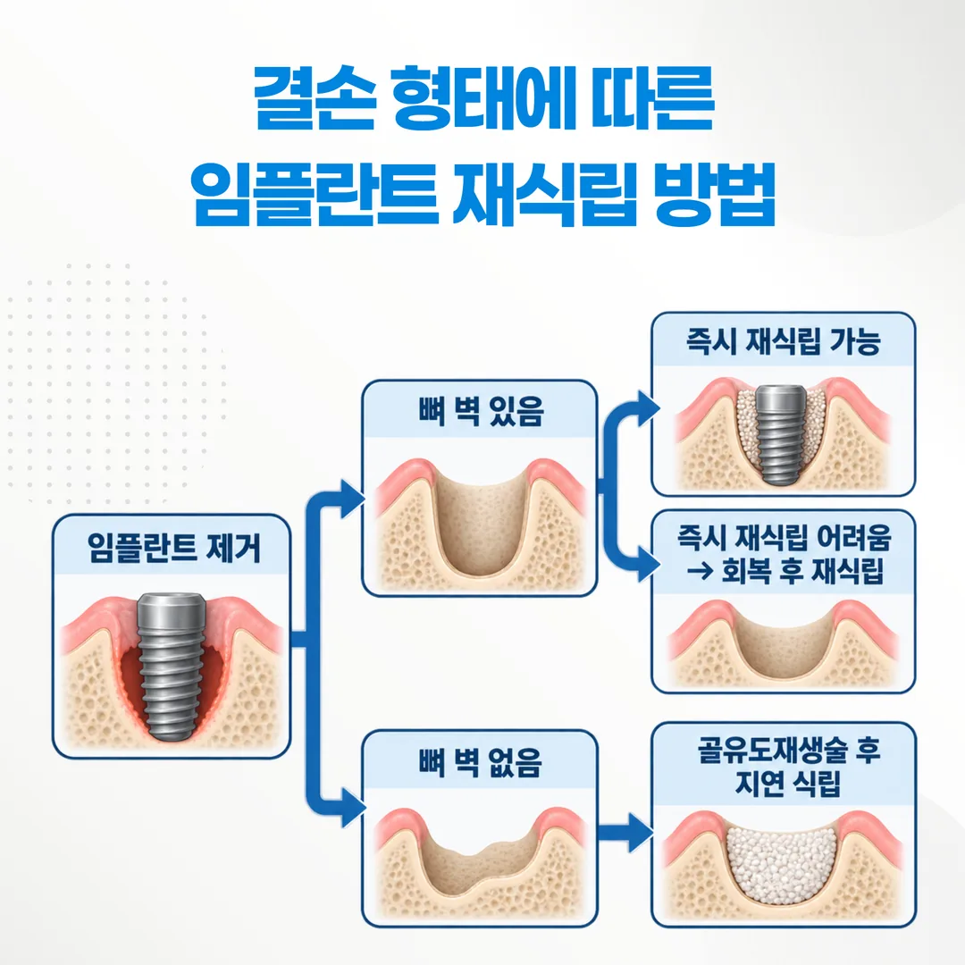 결손 형태별 재식립 경로 비교도