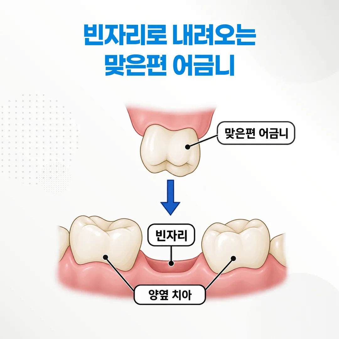 어금니 한 자리가 비어 있는 치열과 주변 치아의 위치 관계 모식도