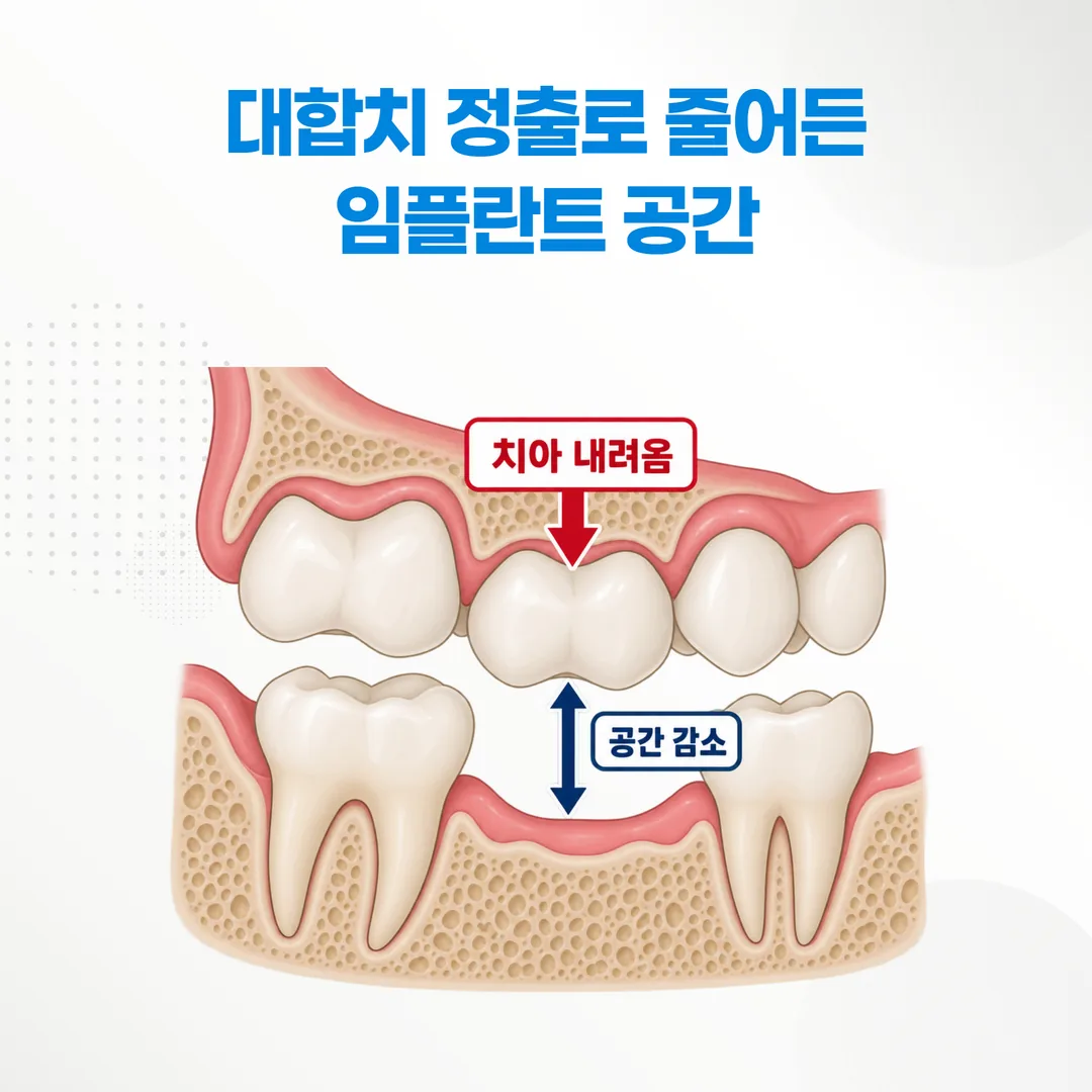 대합치 정출로 인공 치아가 들어갈 높이가 줄어든 상태를 나타낸 단면 개념도