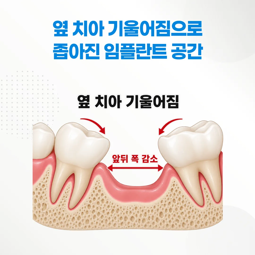 인접치가 기울어 임플란트가 들어갈 앞뒤 폭이 줄어든 상태를 나타낸 개념도