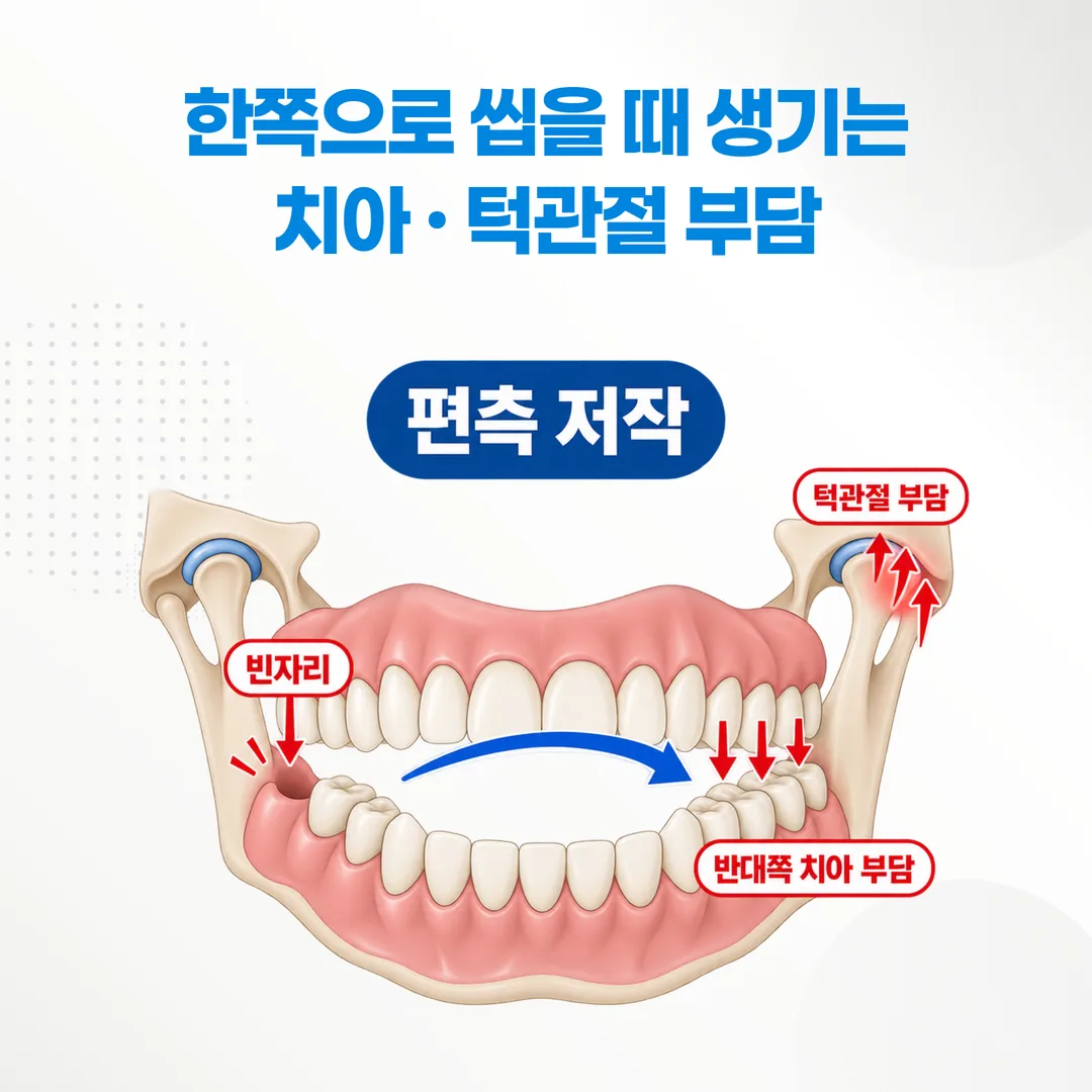 편측 저작으로 반대쪽 치아와 턱관절에 힘이 몰리는 방향을 나타낸 도식