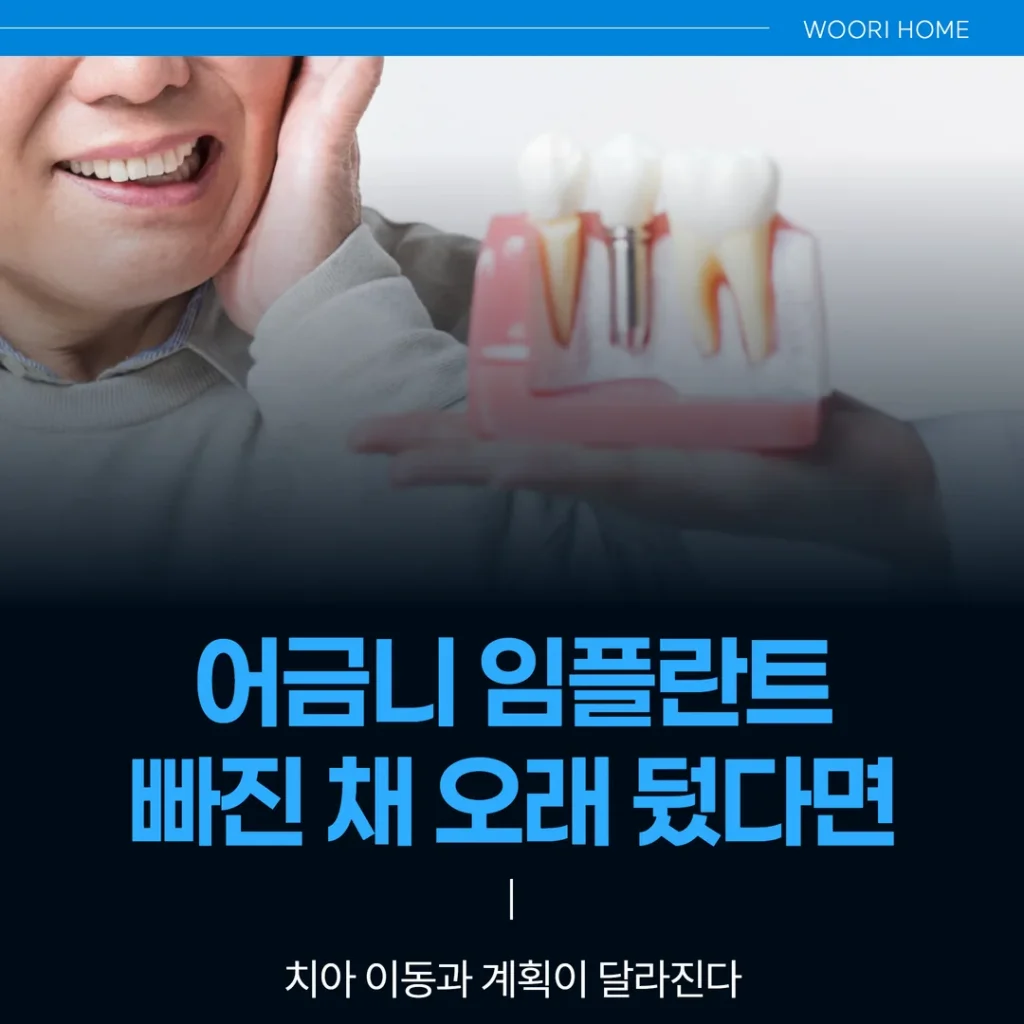 어금니 임플란트, 빠진 채 오래 뒀다면 — 치아 이동과 계획이 달라진다