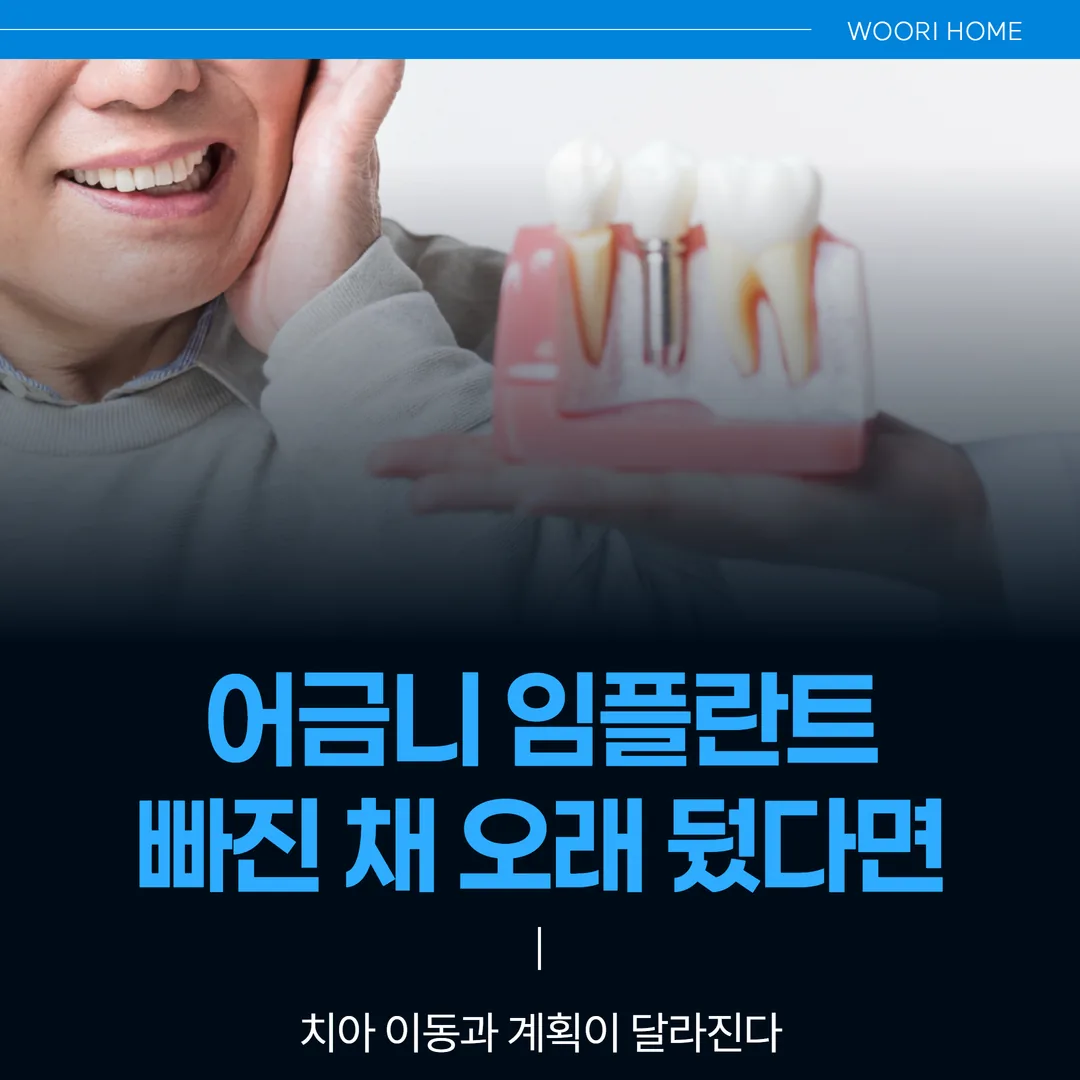 어금니 임플란트, 빠진 채 오래 뒀다면 — 치아 이동과 계획이 달라진다