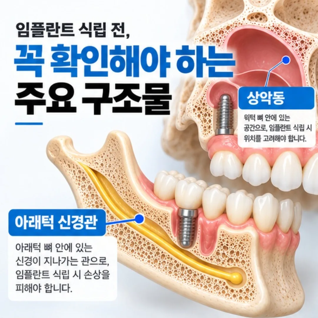 아래턱 신경관과 위턱 상악동의 위치를 표시한 턱뼈 단면 그림
