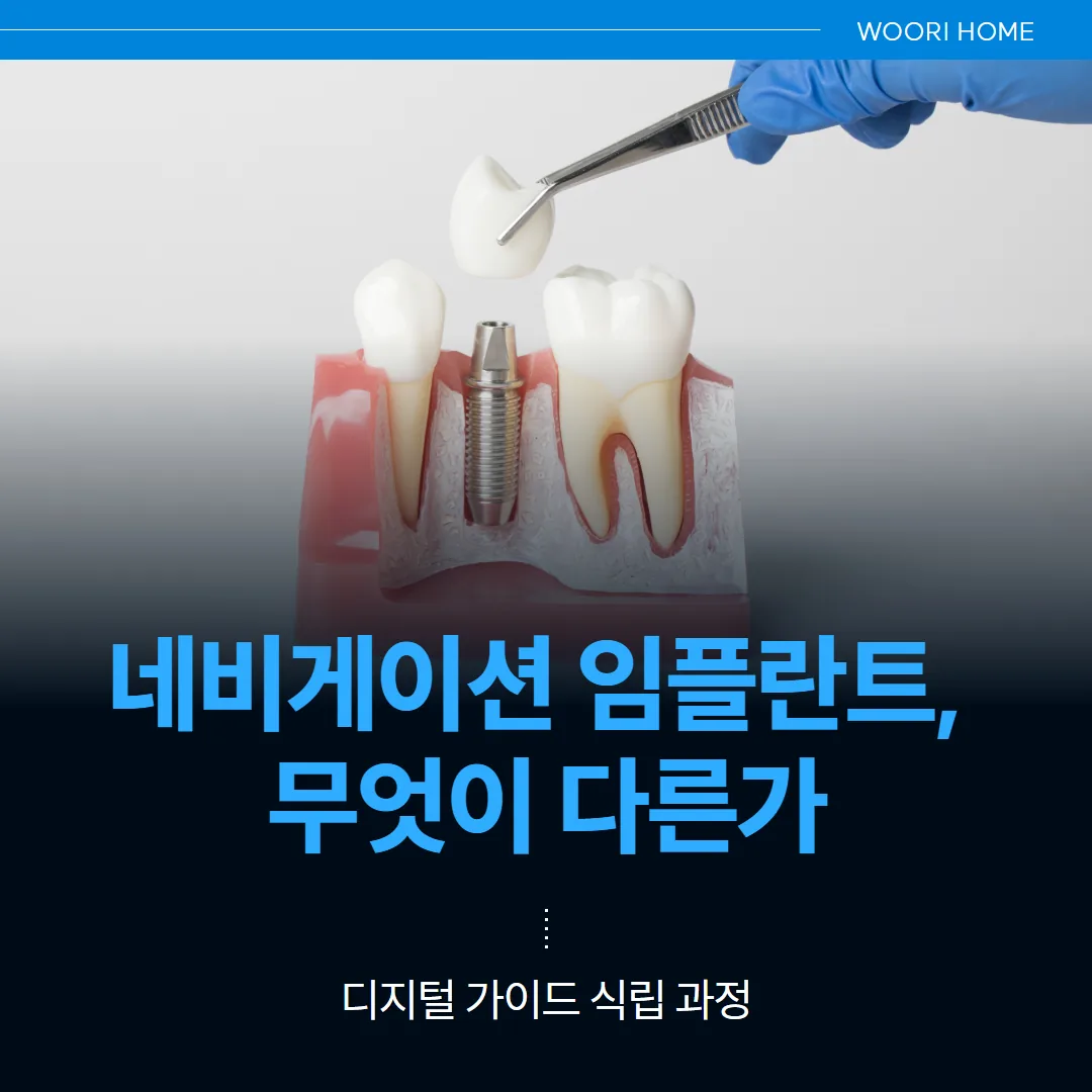 네비게이션 임플란트, 무엇이 다른가 — 디지털 가이드 식립 과정