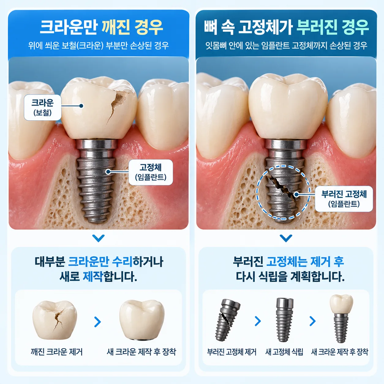 임플란트 크라운 나사 구멍의 메움재가 있는 모습과 빠진 모습을 비교한 단면 그림